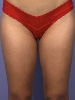 CoolSculpting Before & After Image