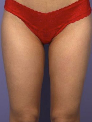 CoolSculpting Before & After Image