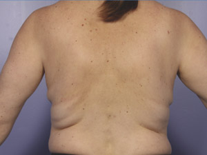 CoolSculpting Before & After Image