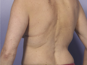 CoolSculpting Before & After Image