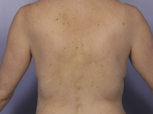 CoolSculpting Before & After Image