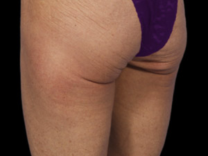 CoolSculpting Before & After Image