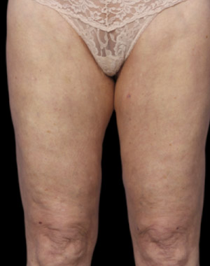 CoolSculpting Before & After Image