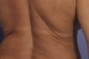 CoolSculpting Before & After Image