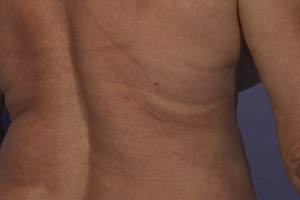 CoolSculpting Before & After Image