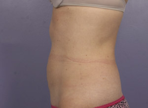 CoolSculpting Before & After Image