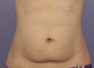 CoolSculpting Before & After Image