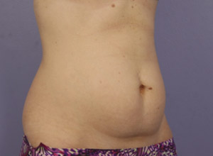 CoolSculpting Before & After Image