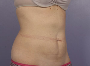 CoolSculpting Before & After Image