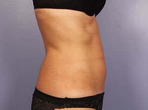 CoolSculpting Before & After Image