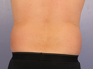 CoolSculpting Before & After Image