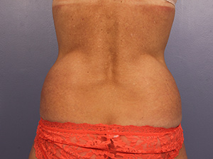 CoolSculpting Before & After Image