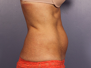 CoolSculpting Before & After Image