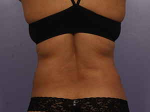 CoolSculpting Before & After Image