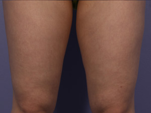 CoolSculpting Before & After Image