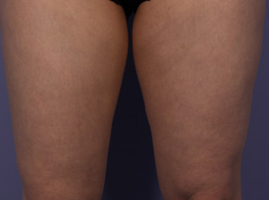 CoolSculpting Before & After Image