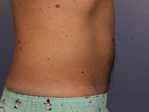 CoolSculpting Before & After Image