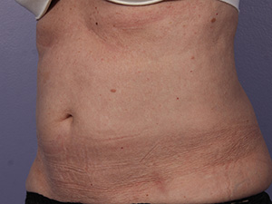 CoolSculpting Before & After Image