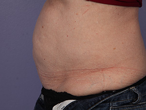 CoolSculpting Before & After Image