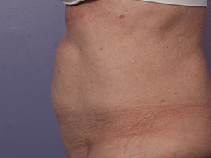 CoolSculpting Before & After Image