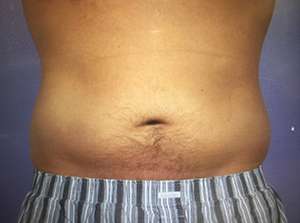 CoolSculpting Before & After Image