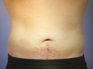 CoolSculpting Before & After Image