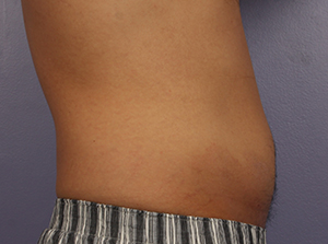 CoolSculpting Before & After Image