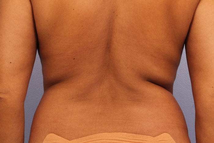 CoolSculpting Before & After Image