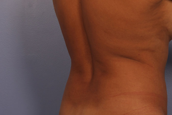 CoolSculpting Before & After Image