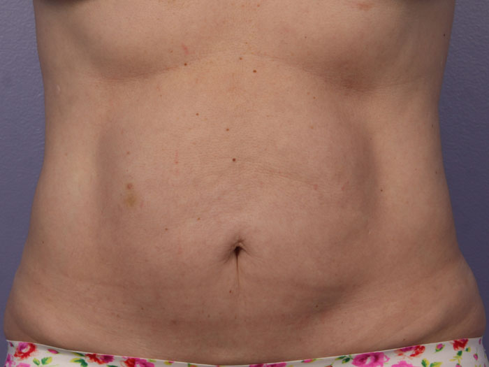 CoolSculpting Before & After Image