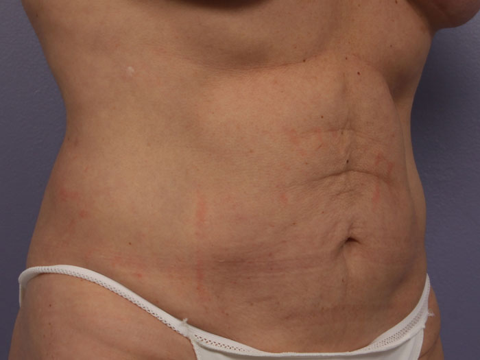 CoolSculpting Before & After Image