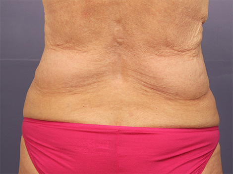 CoolSculpting Before & After Image