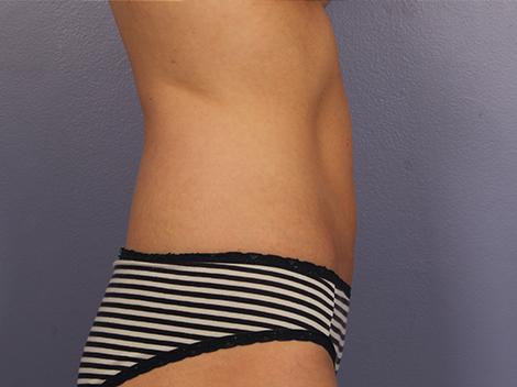 CoolSculpting Before & After Image