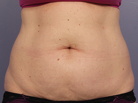 CoolSculpting Before & After Image