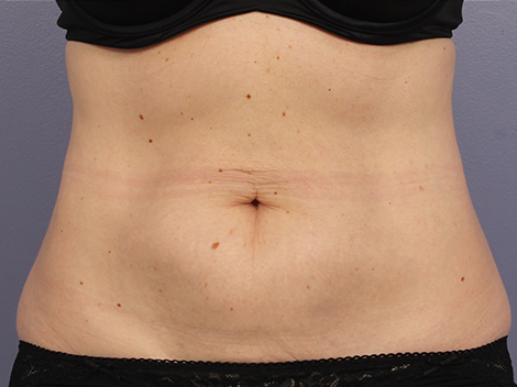 CoolSculpting Before & After Image