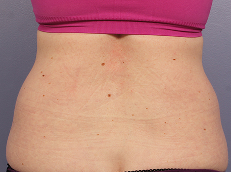 CoolSculpting Before & After Image