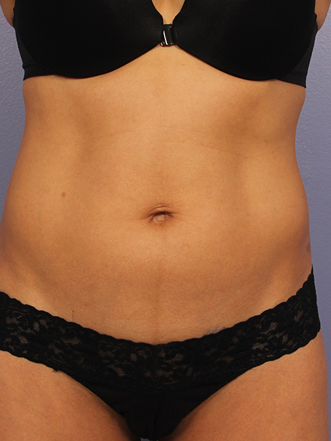 CoolSculpting Before & After Image