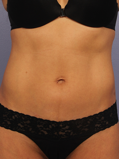 CoolSculpting Before & After Image