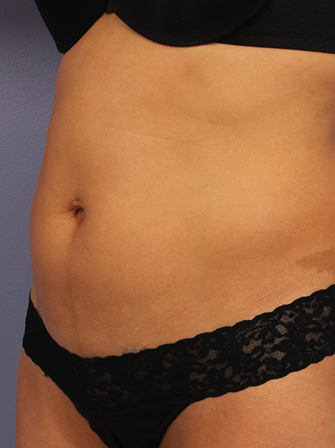 CoolSculpting Before & After Image