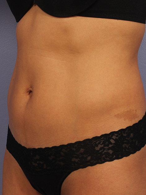 CoolSculpting Before & After Image