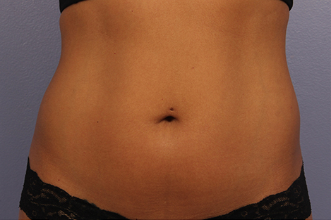 CoolSculpting Before & After Image