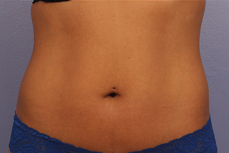 CoolSculpting Before & After Image