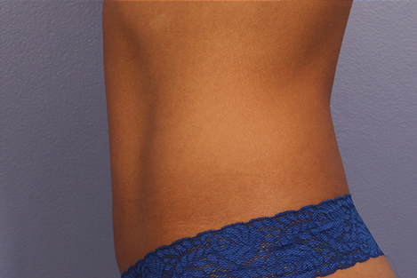 CoolSculpting Before & After Image