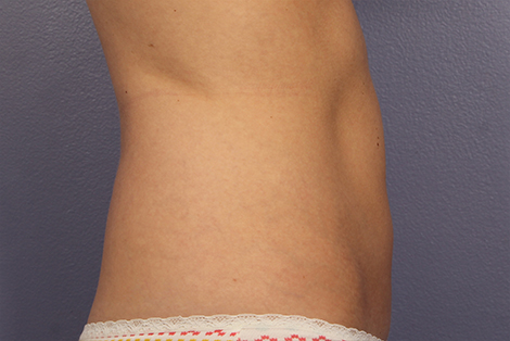 CoolSculpting Before & After Image