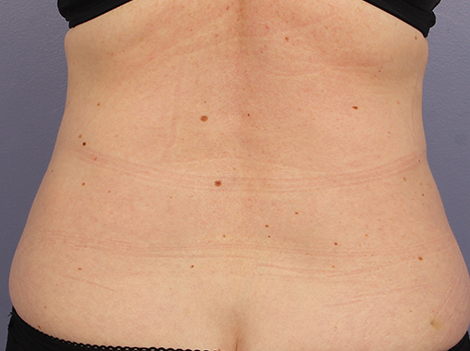 CoolSculpting Before & After Image