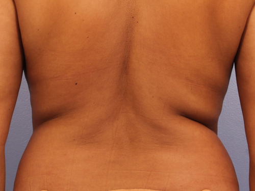 CoolSculpting Before & After Image