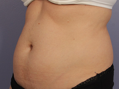 CoolSculpting Before & After Image