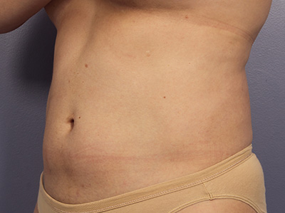 CoolSculpting Before & After Image