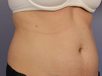 CoolSculpting Before & After Image