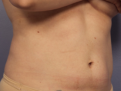 CoolSculpting Before & After Image